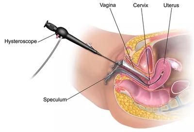 宫腹腔镜示意图